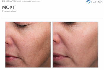 moxi laser for rosacea in blackburn