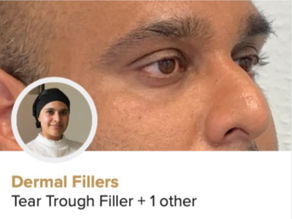 Tear trough dermal to reduce a true eye hollow.