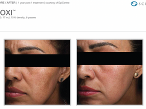 Moxi® laser resurfacing results after one treatment.