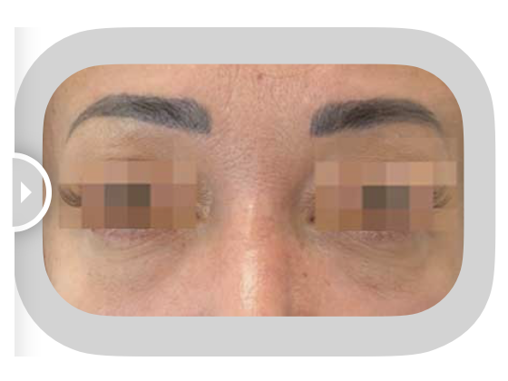 Sunekos Eyes, After. Images Courtesy of sunekos.com