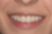 (SH)After- Full mouth rehabilitation with upper and lower porcelain crowns on natural teet