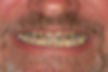 (GH) Before-Upper Anterior porcelain Veneers and Implant Crowns.jpg