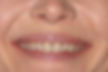 (LS) Before- Full upper Rehabilitation with Porcelain Crowns.jpg