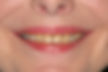 (JVH) Before-Smile-Anterior Porcelain Crowns.jpg