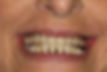 (HR) before - Upper Conventional Full denture and lower porcelain crowns and bridge.jpg