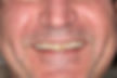 (MK) Before-Full upper porcelain veneers and implant crown.jpg