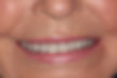 (GW) After-Full mouth rehabilitation with porcelain crowns on natural teeth.jpg