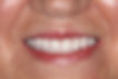 (DC) After-Implant supported Dentures.jpg