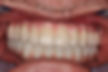 (JM) after-upper and lower fixed implant bridges.jpg