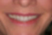 (NP)Before- Full mouth rehabilitation with porcelain crowns on natural teeth and implants.