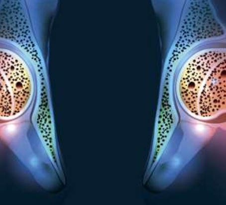 Assessing the Health of Our Bones - Part II: Bone Quality & Bone Health Measurement Tools