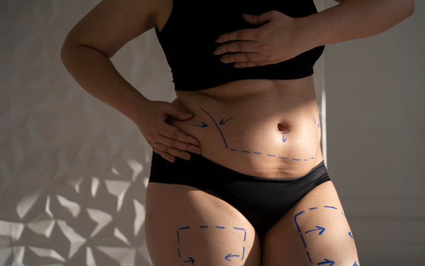 Miniabdominoplastia e lipoaspiração