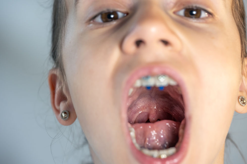 Mordida aberta em crianças