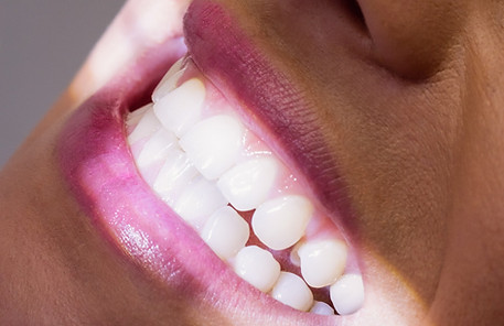 Facetas e lentes de contato dental Florianópolis