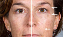 Anti aging behandeling