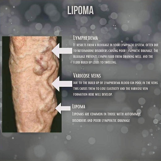 lipoma 4_edited.jpg