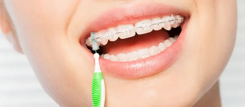 How Long Does Orthodontic Treatment Really Take?
