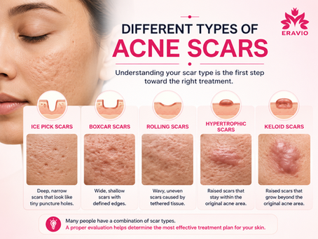 Different Types of Acne Scars Explained: How to Identify Them and What Treatments May Help