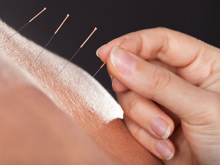 New Back Pain Guidelines Endorse Acupuncture, Manipulation!