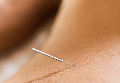 Woman%20Receiving%20Acupuncture_edited.jpg