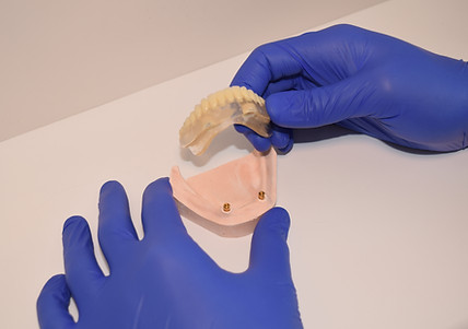 Implant-retained dentures