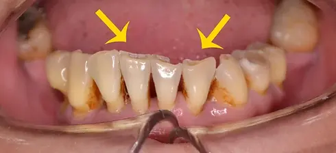 signs-of-bruxism.jpg