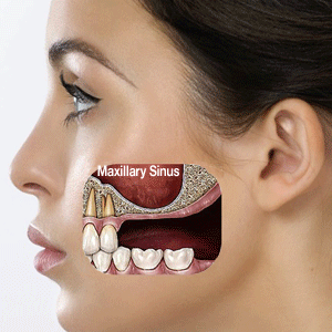 300_maxillary-sinus.gif