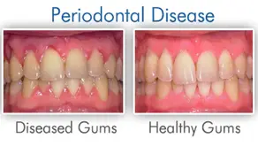 What You Should Know About Dental Implants And Gum Disease