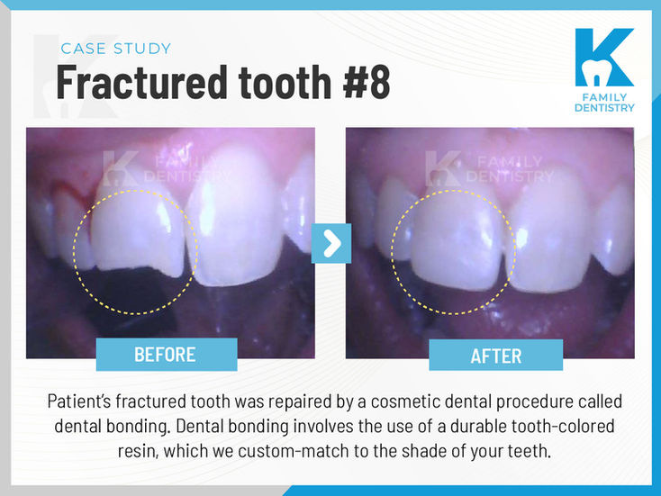 K Family Dentistry in Pflugerville, TX 78660 Emergency, Invisalign, Family ,Cosmetic - Dental Implants, Crowns, Bridges, Restorations, Veneers, Filling, Root Canal Therapy, ClearCorrect, Dentures, Teeth whitening, Inlays and onlays, Sedation Dentistry, Emergency Dentist, Kid Friendly Dentist, Dental Checkup, Cleaning & Examinations