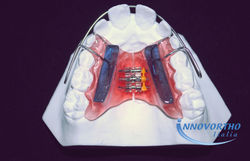 innovortho-italia-PLACCHE PLANAS II CLAS