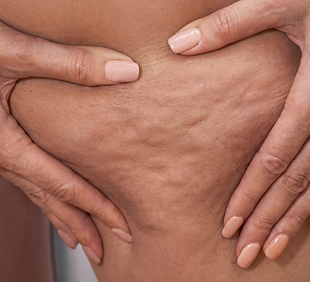 Cellulitetherapie mit Stosswelle und Indiba Radiofrequenztherapie