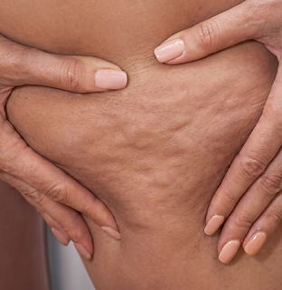 Cellulitebehandlung in der medizinischen Kosmetik Basel