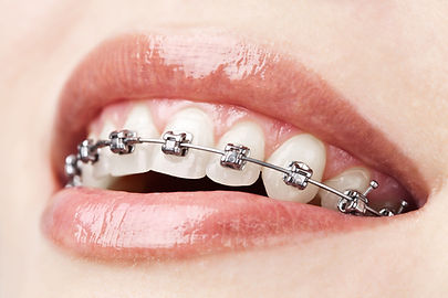 Braces in Norwalk CT.jpeg