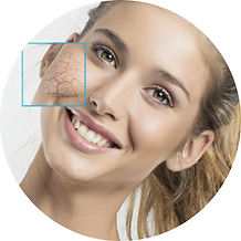 Micro-dermabrasion genève