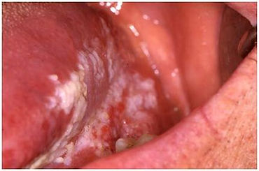 Leucoplasia do Bordo da Lingua