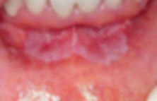 Leucoplasia