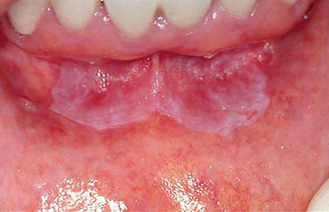 Leucoplasia