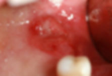 Carcinoma Palato