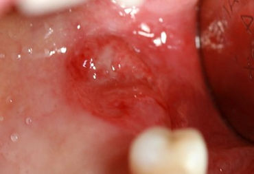 Carcinoma Palato