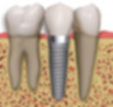 Implante Dental