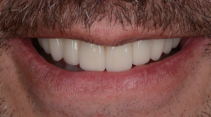 h.g.porcelán héj kerámia héj fogorvos budapest esztétikai fogászat mosolytervezés mosolyrendezés smile design foghéj fogpótlás előtte-utána korona .héj .implantáció smile makeover.png