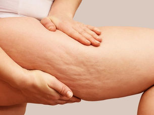 Comment raffermir votre peau et lisser la cellulite sans douleur ?