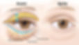 schema-blepharoplastie