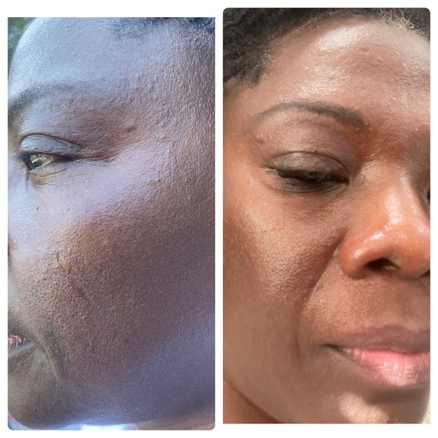 before and after of acne treatment facial