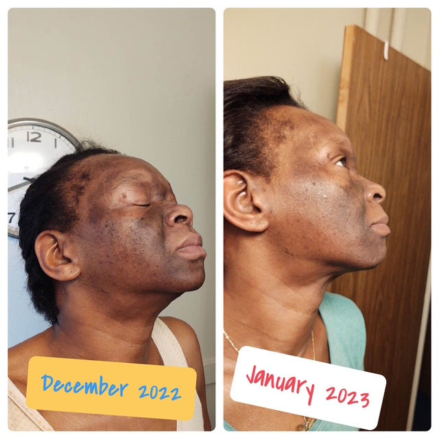 before and after of acne treatment facial