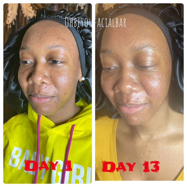 before and after of acne treatment facial