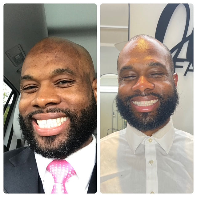 before and after of acne treatment facial