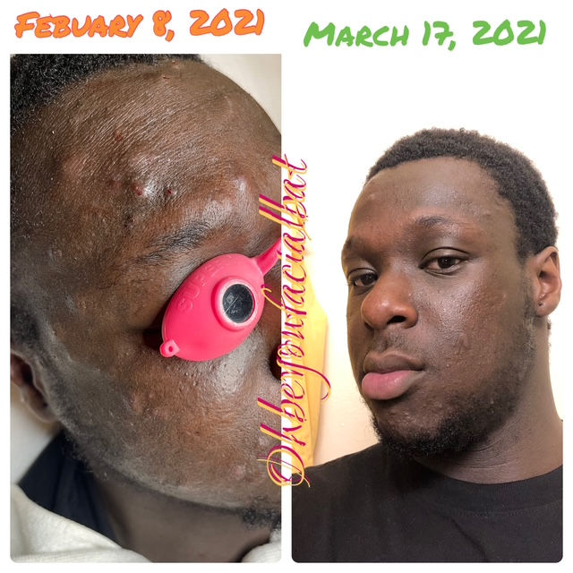 before and after of acne treatment facial