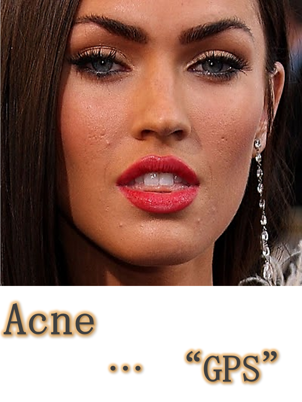 Acne..."GPS"