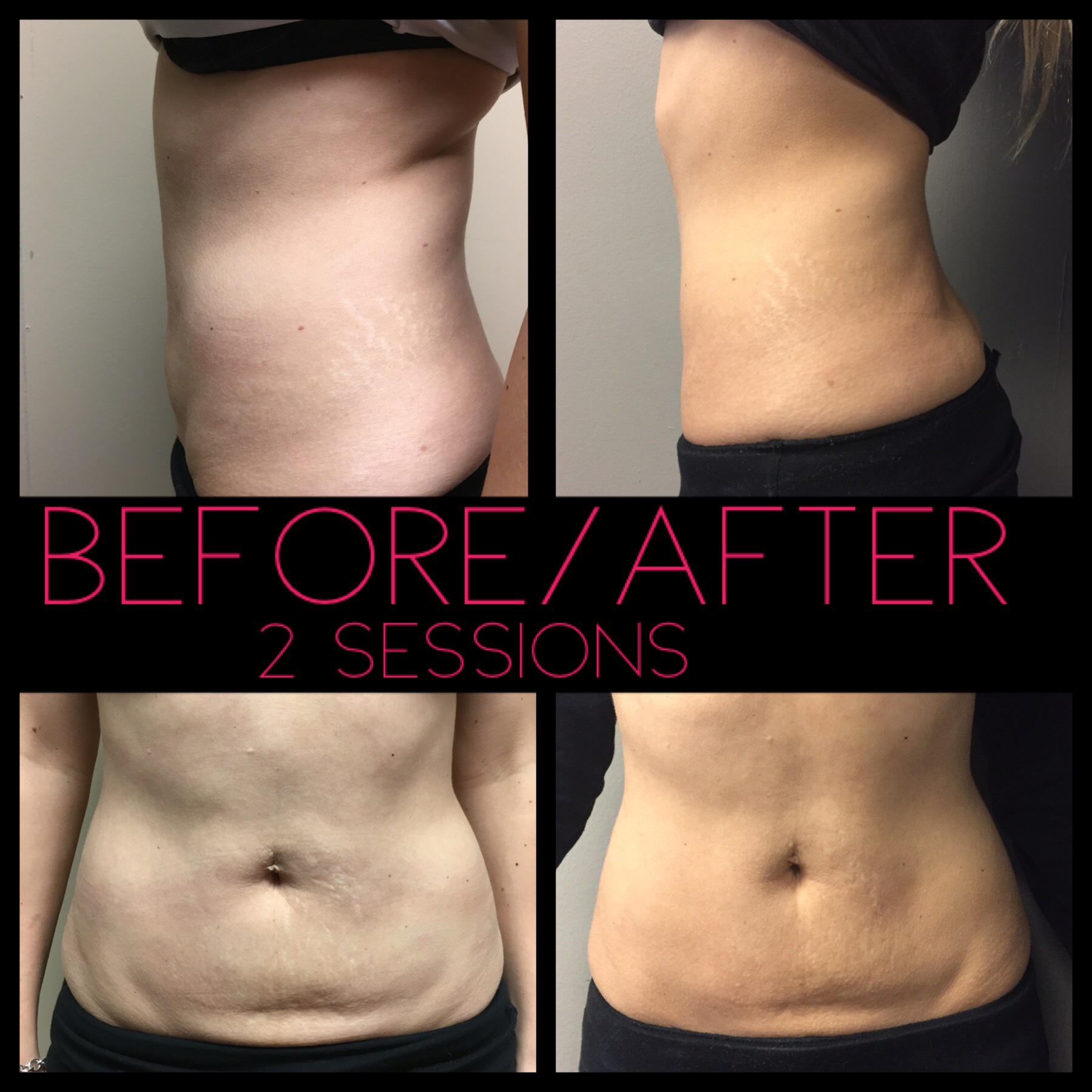 Non-Invasive Lipo